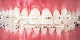 矯正治療中の歯