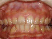 奥歯のインプラント治療前